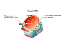Что такое глаукома ответы